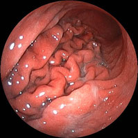 図：６   ピロリ菌感染し、ダメージが大きくなった胃